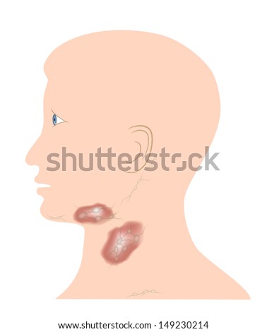 lymph node in swollen Adult