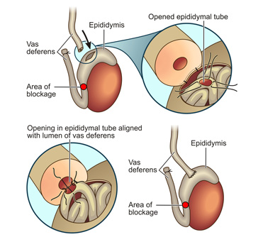 sex reversal vasectomy after Having a
