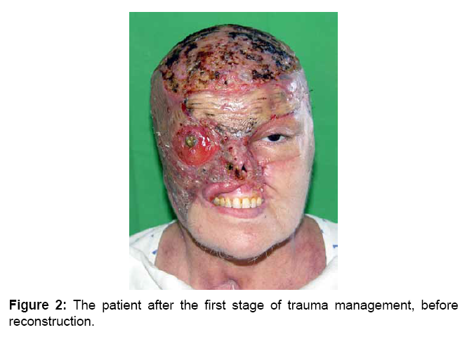 reconstruction Facial trauma