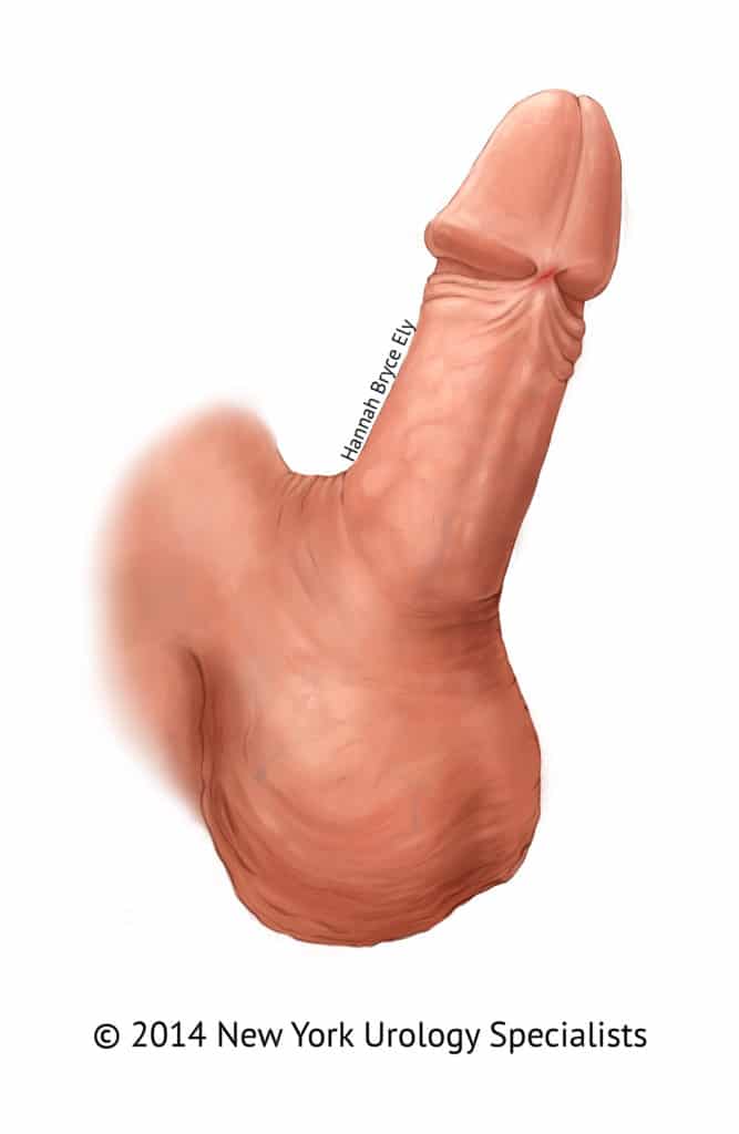 frenulum penis Tight
