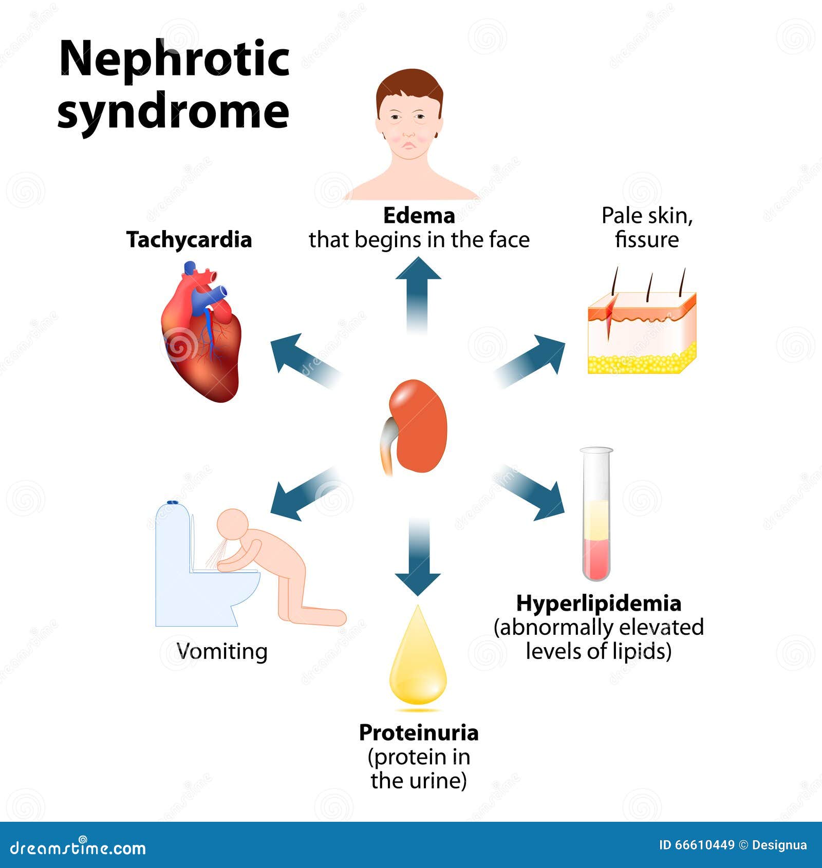 nephrotic syndrome Adult