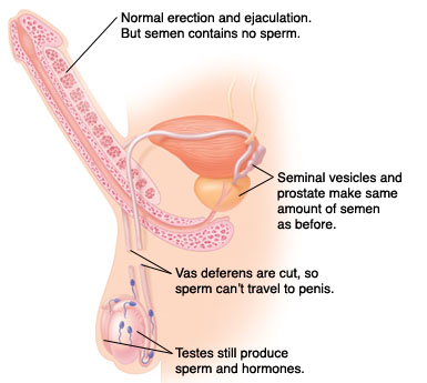 sex reversal vasectomy after Having a