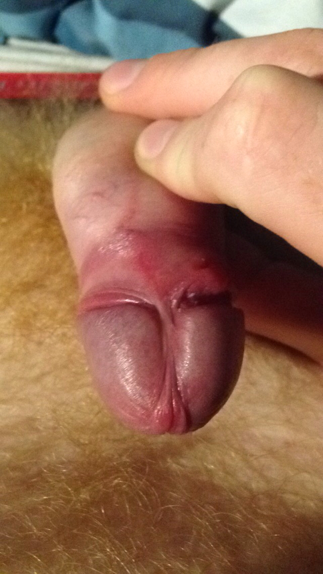 frenulum penis Tight